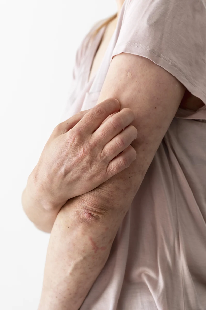PSORIASIS