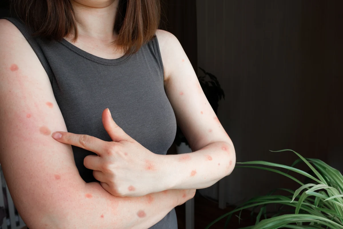 Psoriasis